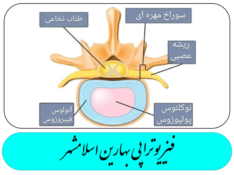 دیسک های بین مهره ای