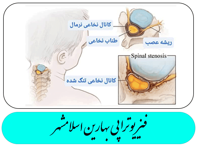 تنگی کانال نخاعی