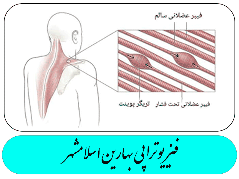 اسپاسم عضلانی