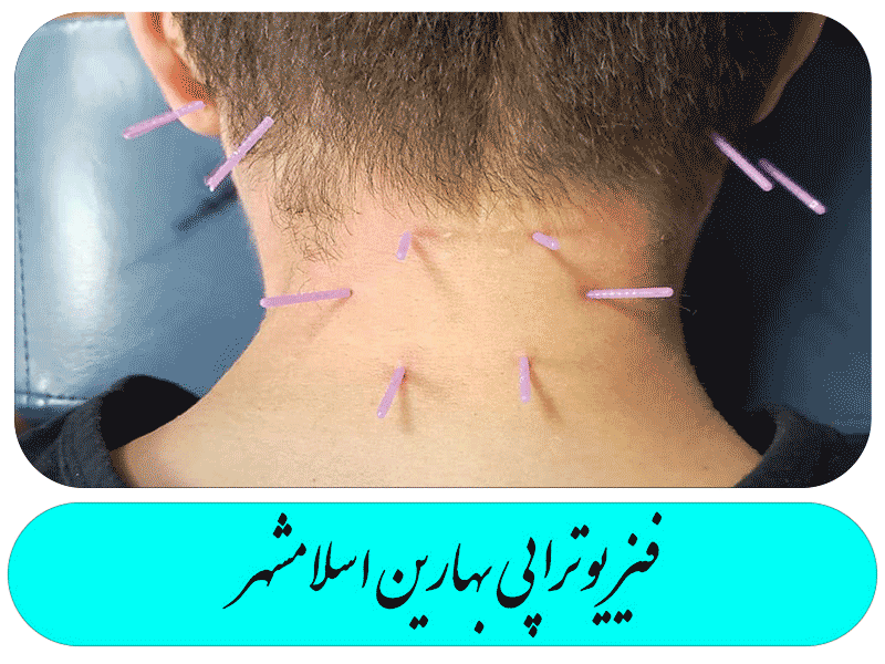 تحریک سوزن تریگرپوینت