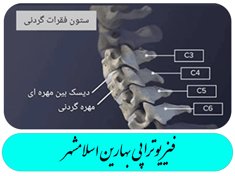 دیسک گردن 
