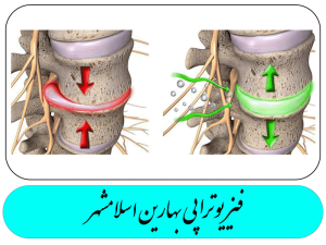 بیرون زندگی دیسک کمر