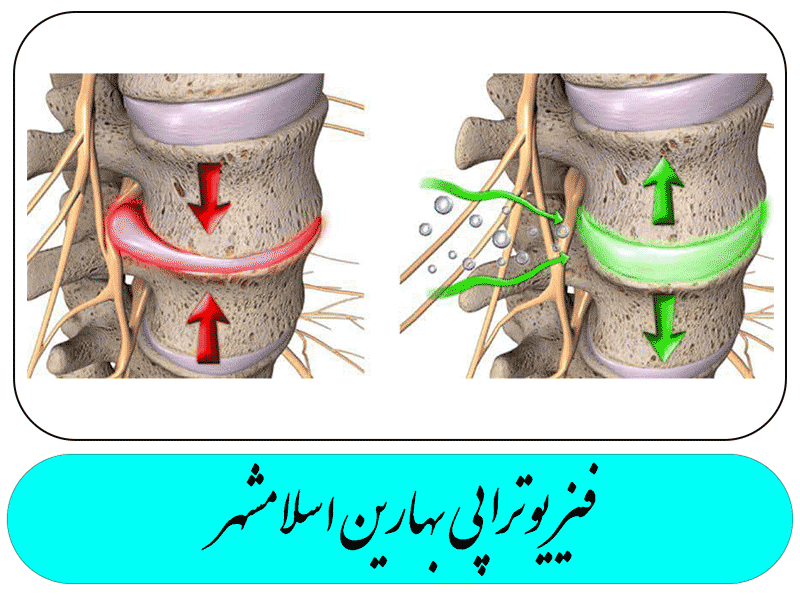بیرون زندگی دیسک کمر