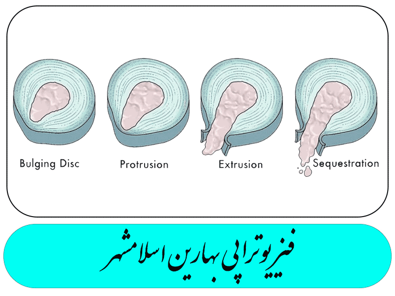 بیرون زدگی دیسک بر اساس شدت