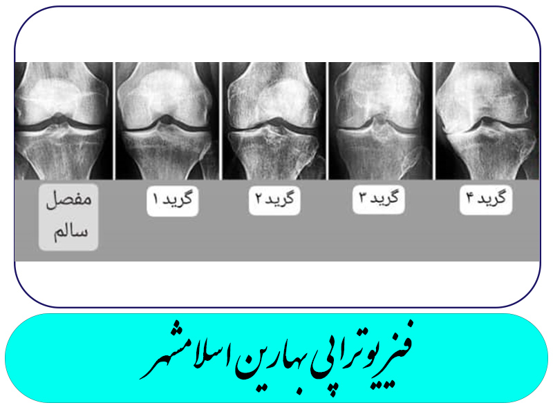 آسیب های شایع در مفصل زانو