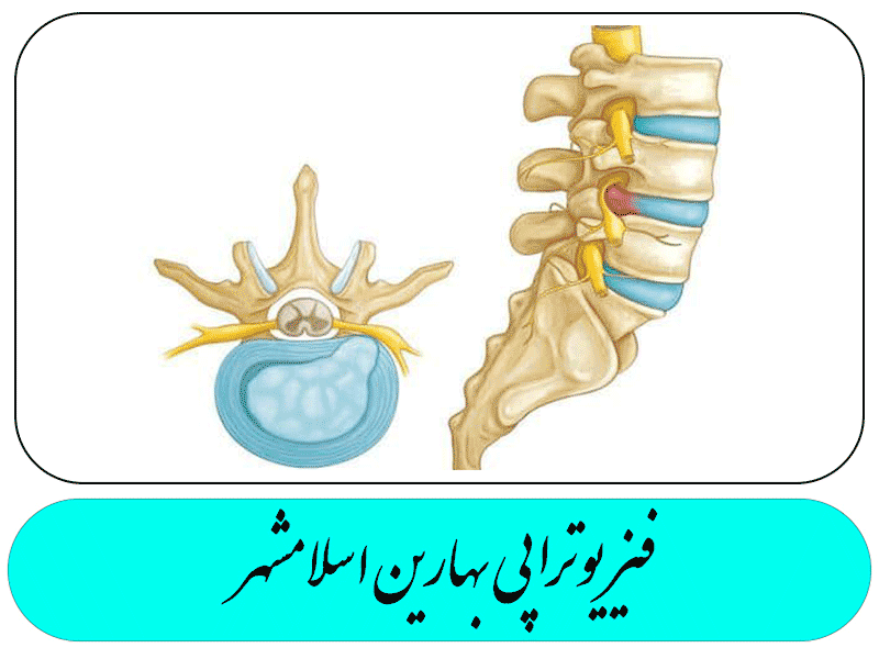 تنگی کانال نخاعی انسان