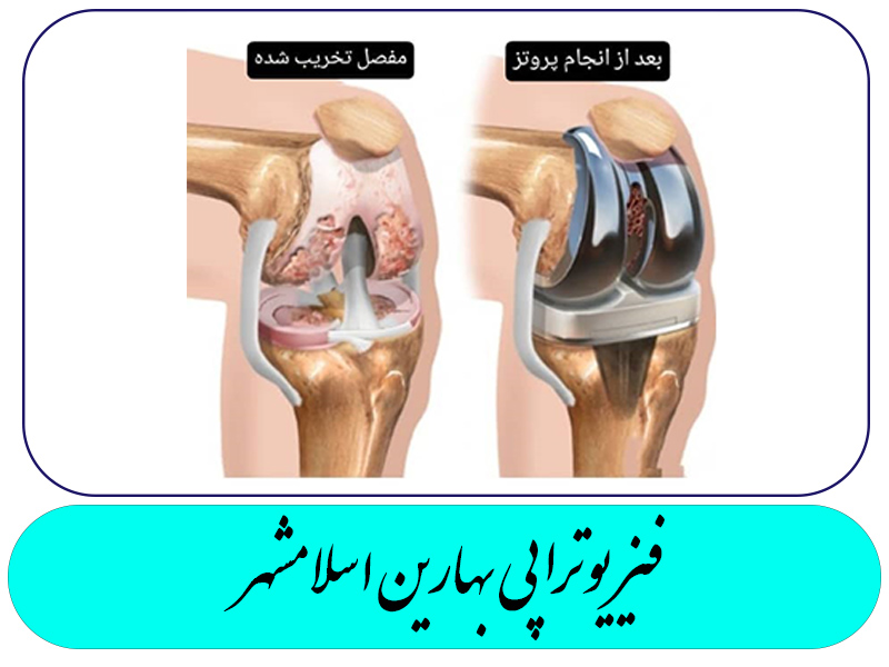 تعویض مفصل زانو Total Knee Arthroplasty