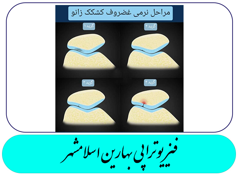احساس کریتپاسیون یا Grinding در مفصل پتلوفمورال