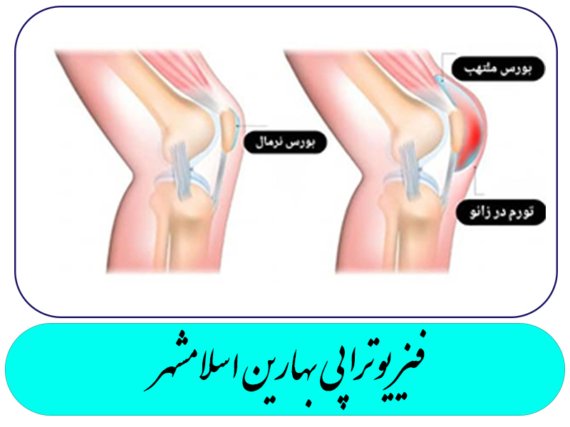 علائم بورسیت زانو را بشناسیم