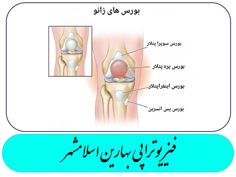 بورسیت ایلیوتیبیال