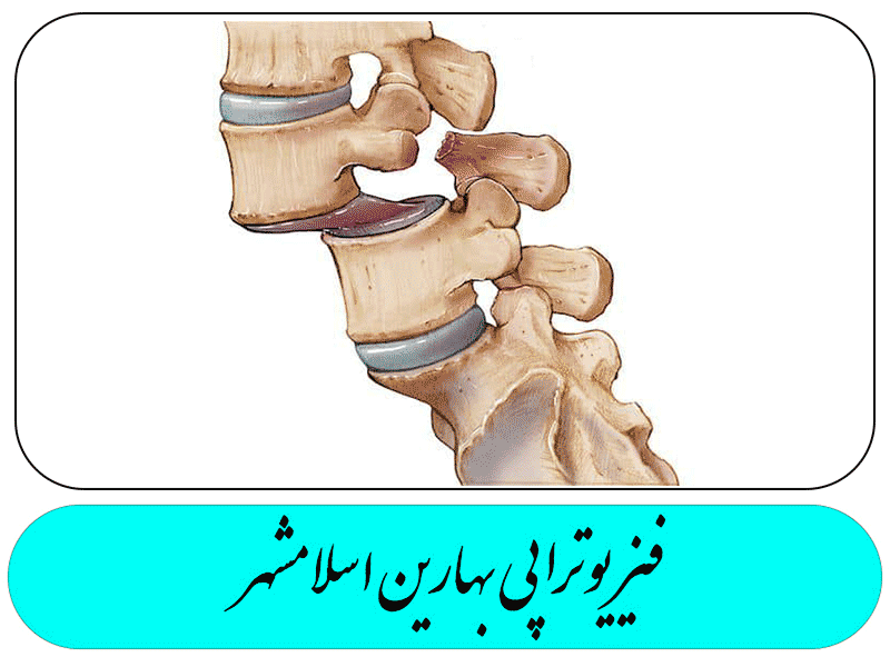 سر خوردگی مهره کمر