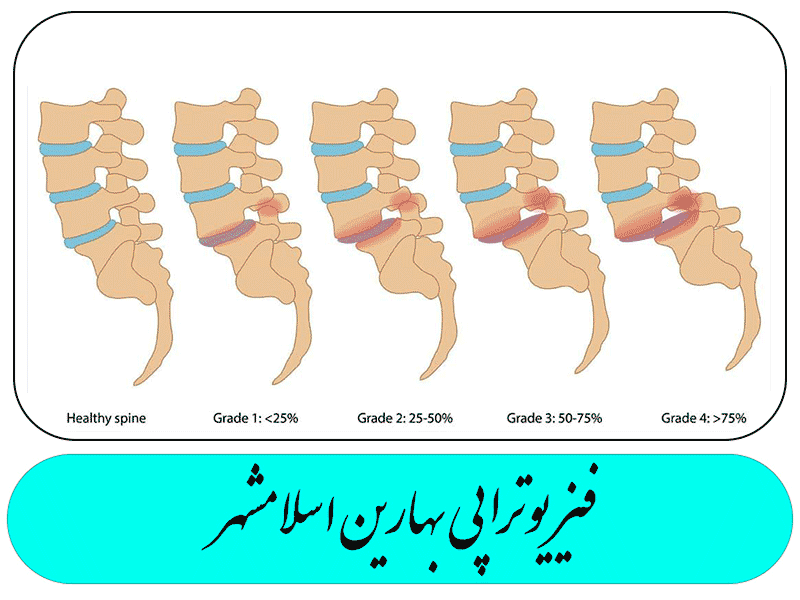 سندرم دم اسبی